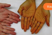 როგორ ვლინდება ღვიძლის პრობლემები კანზე და სხეულში?!