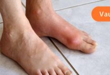 როგორ მოვიშოროთ ორგანიზმიდან შარდმჟავას კრისტალები, რომ თავიდან ავიცილოთ პოდაგრას გაჩენა?!