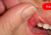 თქვენ არ შეგიძლიათ მათი იგნორირება! ორგანიზმში ფოლიუმის მჟავას დეფიციტის 7 ნიშანი!