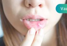 სტომატიტი: ხალხური მეთოდი, რომელიც დაგეხმარებათ პრობლემის მოგვარებაში რამდენიმე წუთში