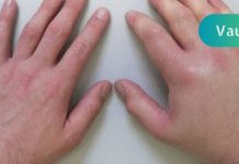 რატომ შუპდება თითები? 5 შესაძლო მიზეზი თუ რამ შეიძლება გამოიწვიოს აღნიშნული პრობლემა!