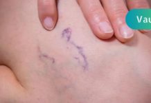 8 წესი, რომელიც უნდა დაიცვათ, თუ გსურთ განკურნოთ ვარიკოზული ვენები!