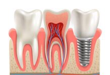 კბილის იმპლანტი: ფასი 2026 წელს – რა ღირს ერთი კბილის იმპლანტი?